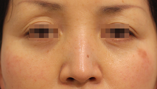 目の周りの症例写真（Before）／40代 女性