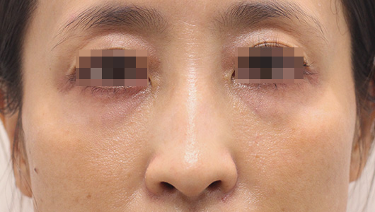 目の周りの症例写真（After）／40代 女性