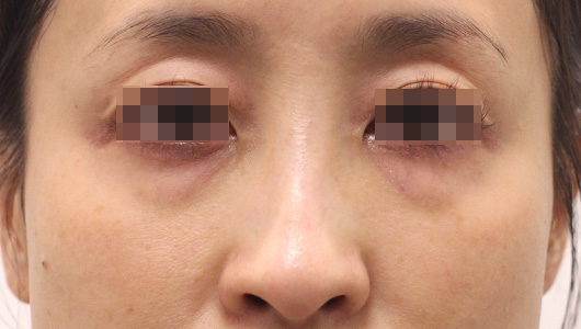目の周りの症例写真（Before）／40代 女性
