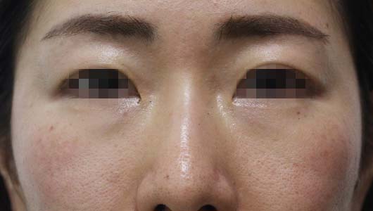 目の周りの症例写真（After）／30代 女性