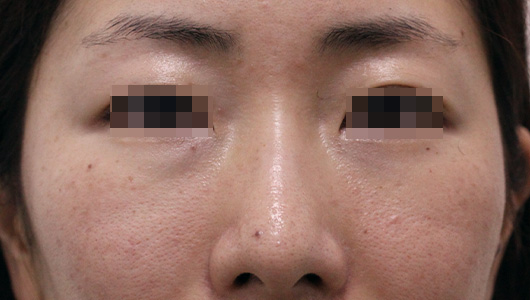 目の周りの症例写真（Before）／30代 女性