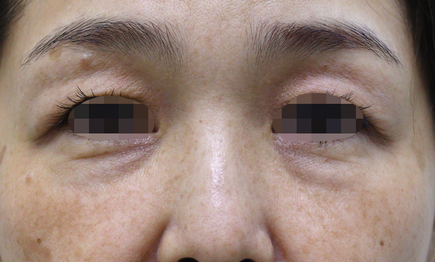 目の周りの症例写真（After）／50代 女性