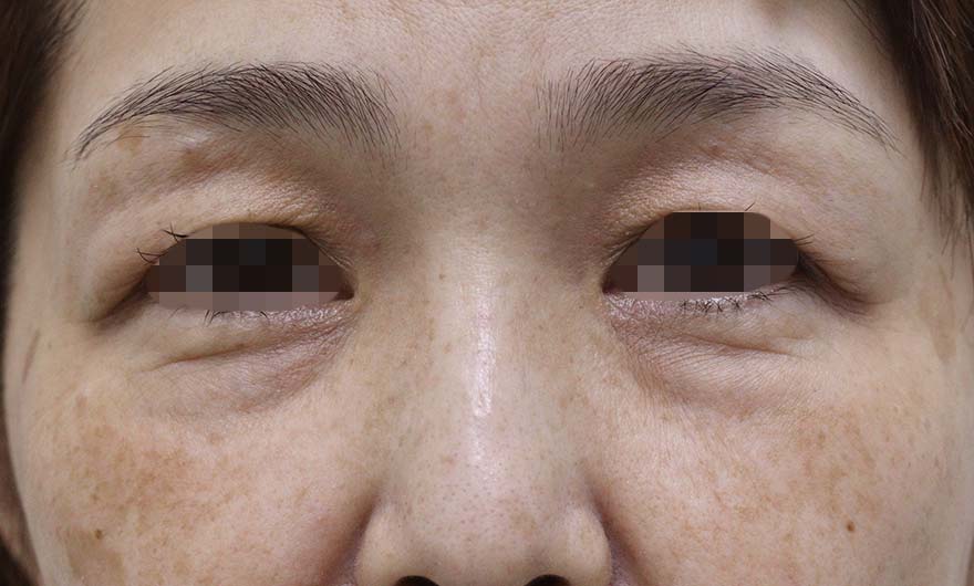 目の周りの症例写真（Before）／50代 女性