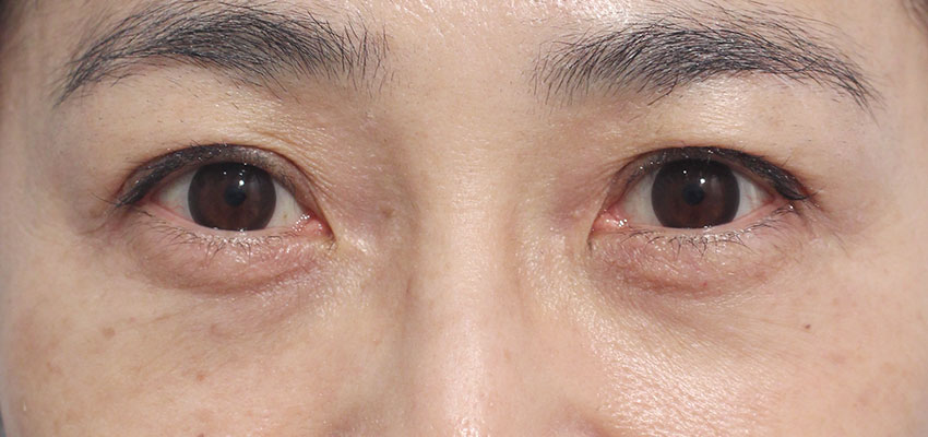目の周りの症例写真（After）／40代 女性
