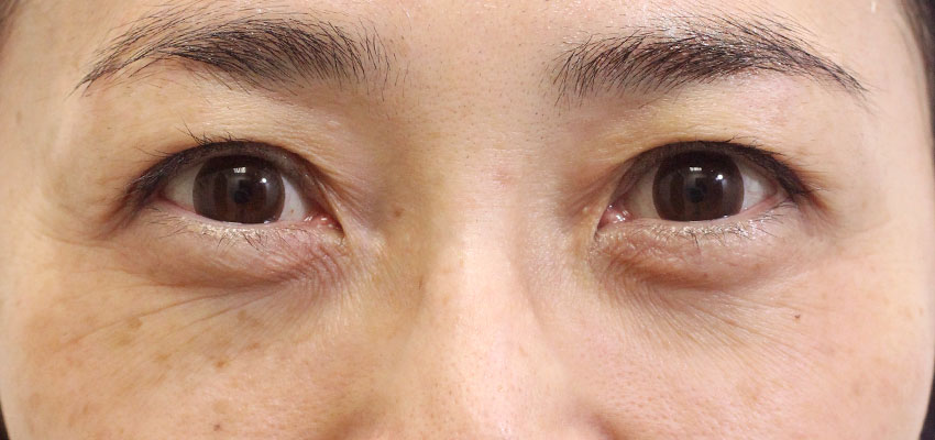 目の周りの症例写真（Before）／40代 女性