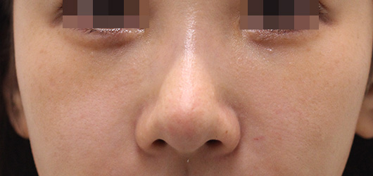 ゴルゴ線の症例写真（After）／20代 女性