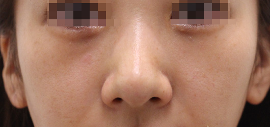 ゴルゴ線の症例写真（Before）／20代 女性