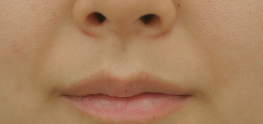 ほうれい線の症例写真（Before）／30代 女性