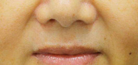 ほうれい線の症例写真（Before）／50代 女性
