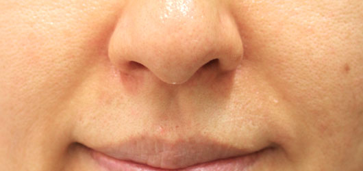 ほうれい線の症例写真（Before）／50代 女性