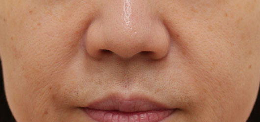 ほうれい線の症例写真（After）／40代 女性