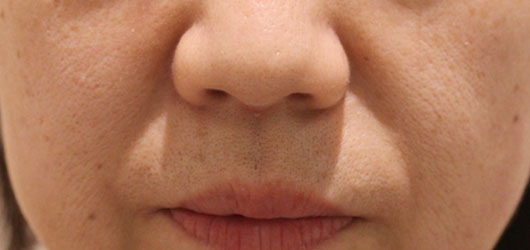 ほうれい線の症例写真（Before）／40代 女性