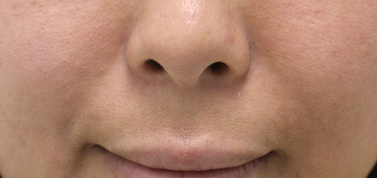 ほうれい線の症例写真（Before）／40代 女性