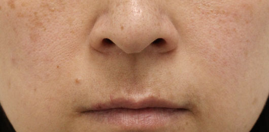 ほうれい線の症例写真（After）／40代 女性