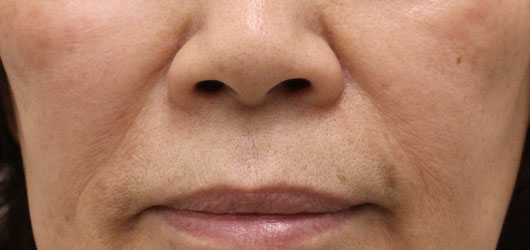 ほうれい線の症例写真（After）／70代 女性