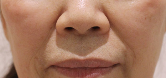 ほうれい線の症例写真（Before）／70代 女性