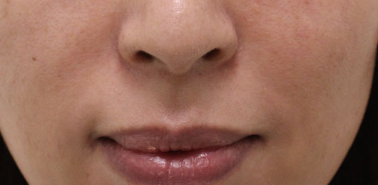 ほうれい線の症例写真（After）／40代 女性