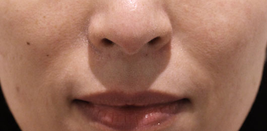 ほうれい線の症例写真（Before）／40代 女性