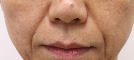 ほうれい線の症例写真（Before）／50代 女性