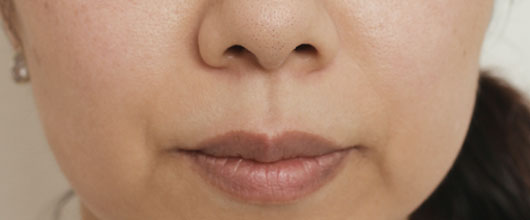 ほうれい線の症例写真（After）／40代 女性