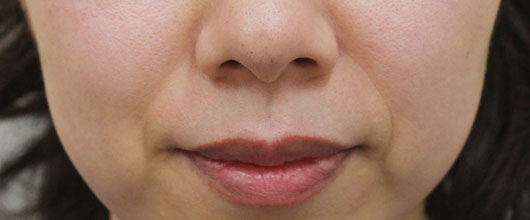 ほうれい線の症例写真（Before）／40代 女性
