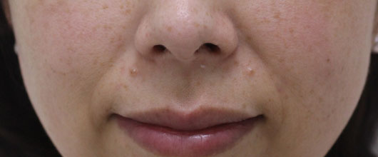 ほうれい線の症例写真（Before）／40代 女性
