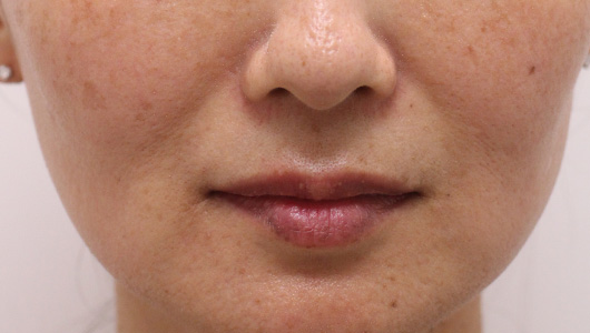 ほうれい線の症例写真（After）／40代 女性