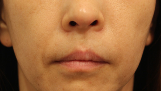 ほうれい線の症例写真（Before）／50代 女性