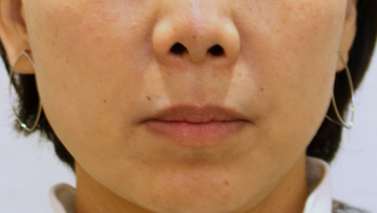 ほうれい線の症例写真（After）／50代 女性