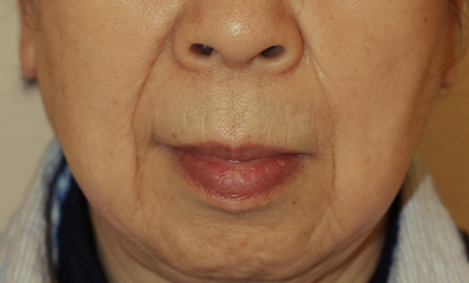 ほうれい線の症例写真（After）／70代 女性