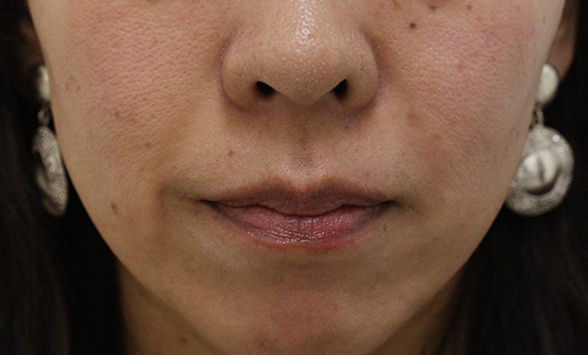 ほうれい線の症例写真（After）／40代 女性