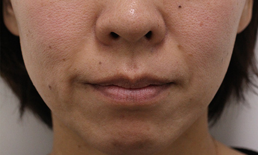 ほうれい線の症例写真（Before）／40代 女性