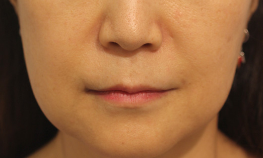 ほうれい線の症例写真（After）／50代 女性