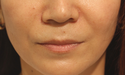 ほうれい線の症例写真（After）／50代 女性