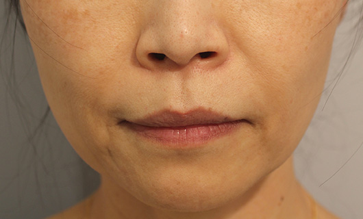 ほうれい線の症例写真（After）／50代 女性