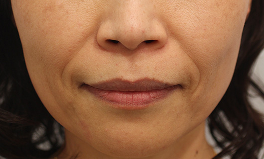 ほうれい線の症例写真（Before）／50代 女性