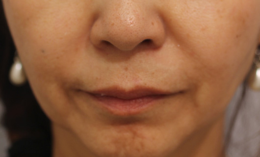 ほうれい線の症例写真（After）／50代 女性