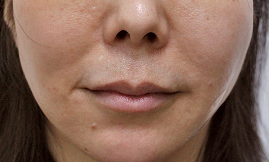 ほうれい線の症例写真（After）／40代 女性