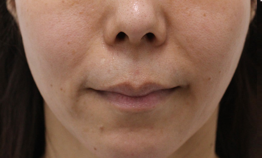 ほうれい線の症例写真（Before）／40代 女性