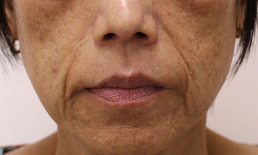 ほうれい線の症例写真（Before）／50代 女性
