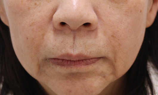 ほうれい線の症例写真（After）／50代 女性