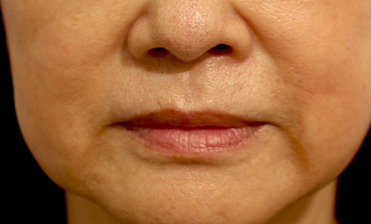 ほうれい線の症例写真（After）／60代 女性