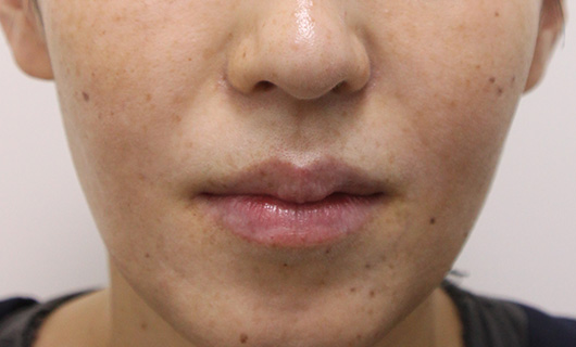 ほうれい線の症例写真（After）／40代 女性