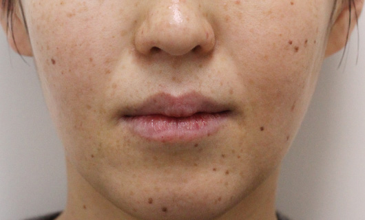 ほうれい線の症例写真（Before）／40代 女性