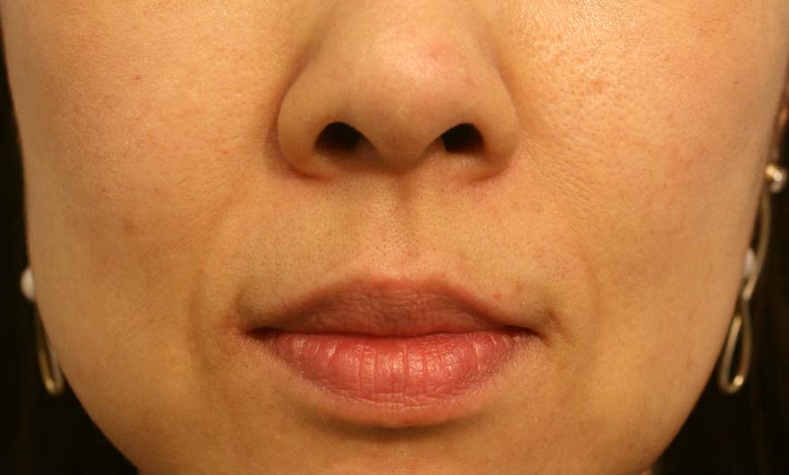 ほうれい線の症例写真（After）／40代 女性