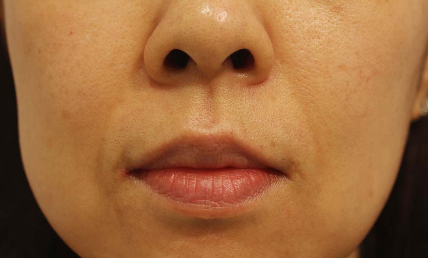 ほうれい線の症例写真（Before）／40代 女性