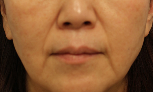 ほうれい線の症例写真（After）／50代 女性