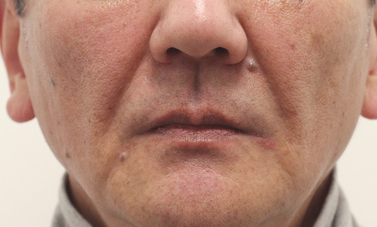 ほうれい線の症例写真（After）／60代 男性