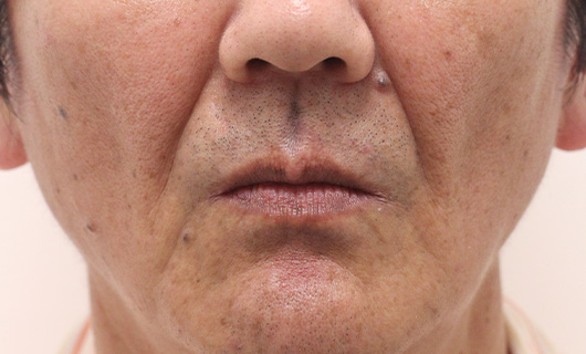 ほうれい線の症例写真（Before）／60代 男性