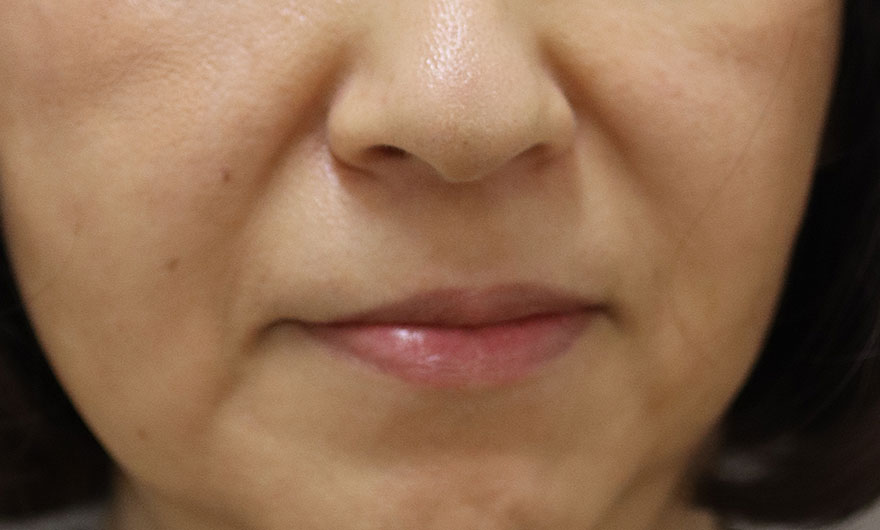 ほうれい線の症例写真（After）／50代 女性